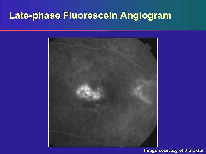 Late-phase Fluorescein Angiogram Image courtesy of J Slakter 