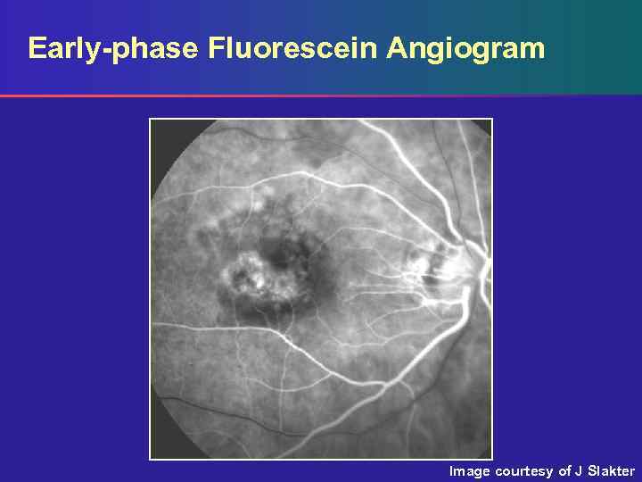 Early-phase Fluorescein Angiogram Image courtesy of J Slakter 