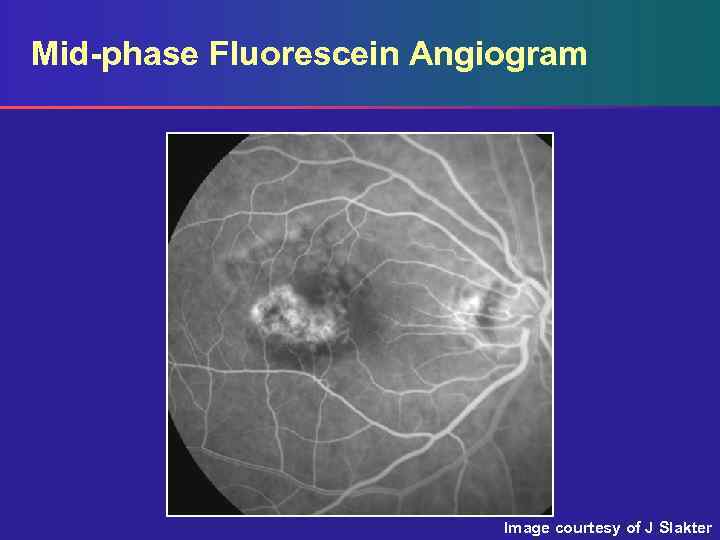 Mid-phase Fluorescein Angiogram Image courtesy of J Slakter 