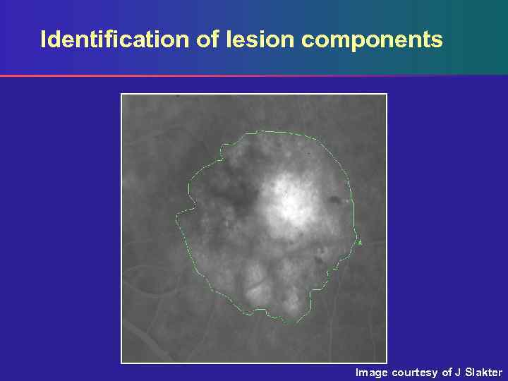Identification of lesion components Image courtesy of J Slakter 