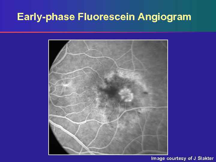 Early-phase Fluorescein Angiogram Image courtesy of J Slakter 