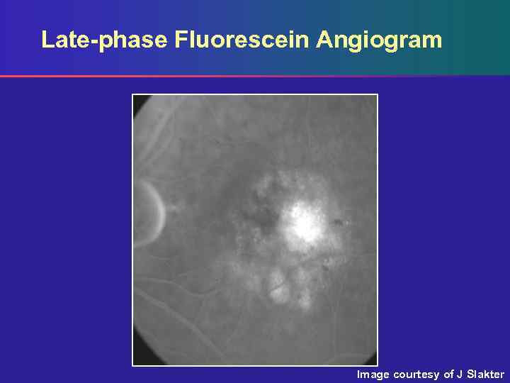 Late-phase Fluorescein Angiogram Image courtesy of J Slakter 