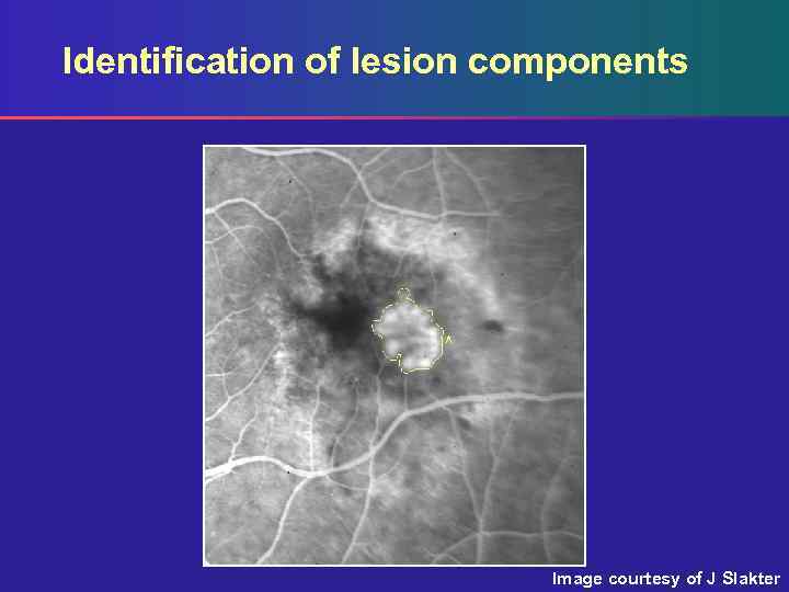 Identification of lesion components Image courtesy of J Slakter 