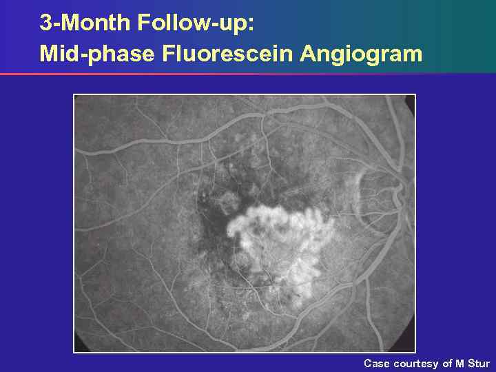 3 -Month Follow-up: Mid-phase Fluorescein Angiogram Case courtesy of M Stur 