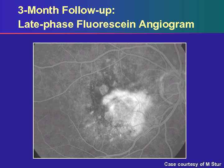 3 -Month Follow-up: Late-phase Fluorescein Angiogram Case courtesy of M Stur 
