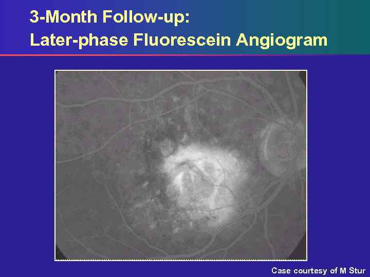 3 -Month Follow-up: Later-phase Fluorescein Angiogram Case courtesy of M Stur 