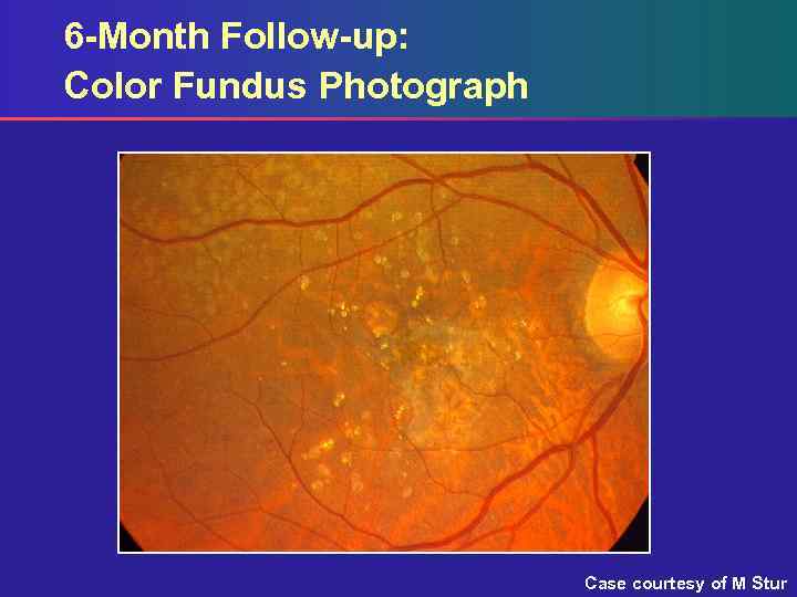 6 -Month Follow-up: Color Fundus Photograph Case courtesy of M Stur 