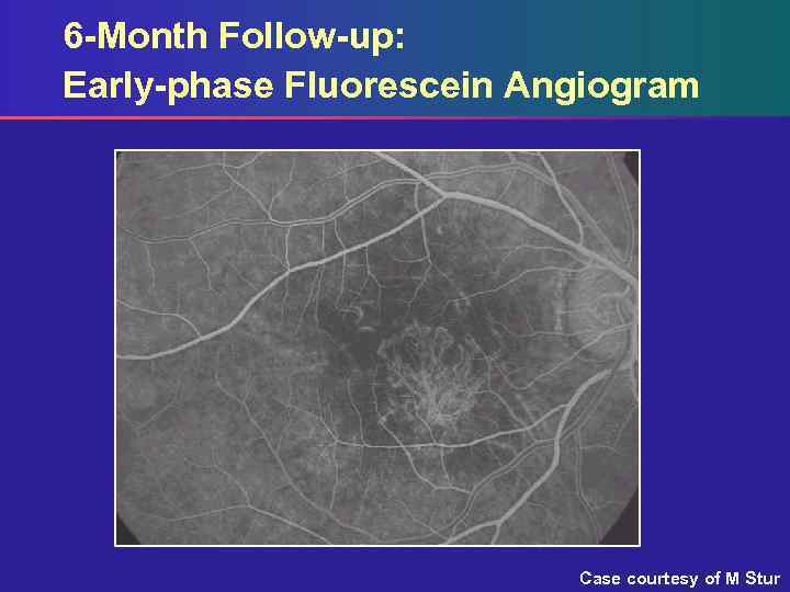 6 -Month Follow-up: Early-phase Fluorescein Angiogram Case courtesy of M Stur 