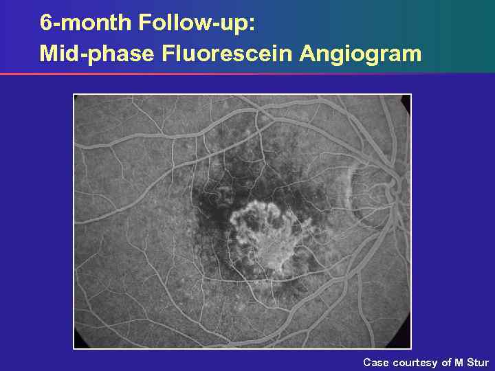 6 -month Follow-up: Mid-phase Fluorescein Angiogram Case courtesy of M Stur 