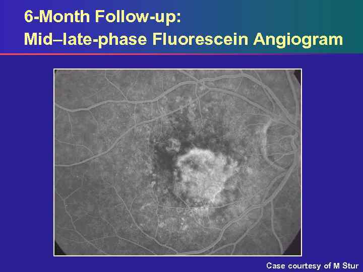 6 -Month Follow-up: Mid–late-phase Fluorescein Angiogram Case courtesy of M Stur 