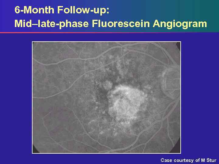 6 -Month Follow-up: Mid–late-phase Fluorescein Angiogram Case courtesy of M Stur 