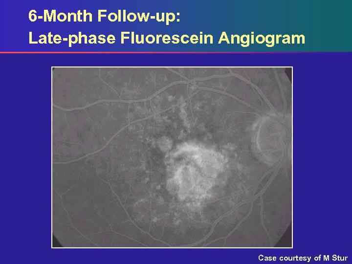 6 -Month Follow-up: Late-phase Fluorescein Angiogram Case courtesy of M Stur 