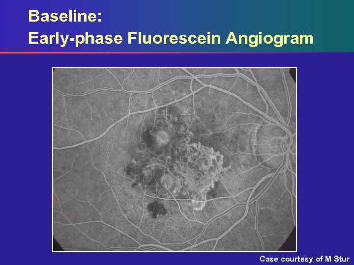 Baseline: Early-phase Fluorescein Angiogram Case courtesy of M Stur 