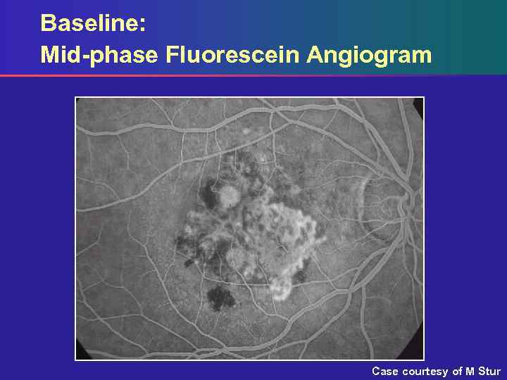 Baseline: Mid-phase Fluorescein Angiogram Case courtesy of M Stur 