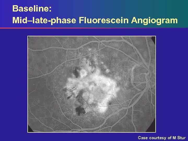 Baseline: Mid–late-phase Fluorescein Angiogram Case courtesy of M Stur 