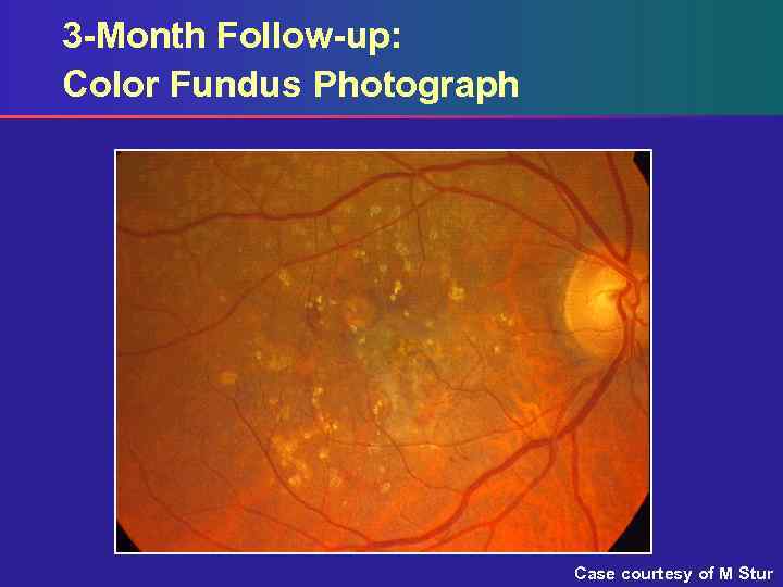 3 -Month Follow-up: Color Fundus Photograph Case courtesy of M Stur 