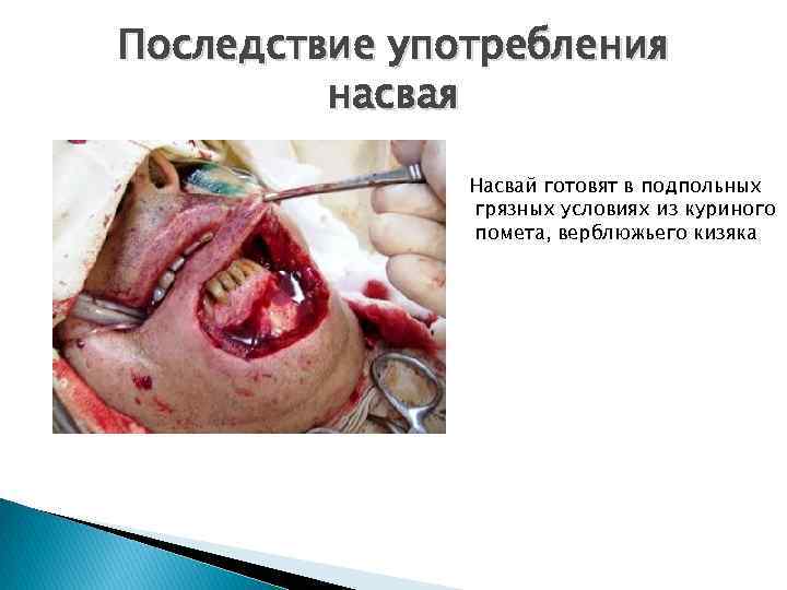 Последствие употребления насвая Насвай готовят в подпольных грязных условиях из куриного помета, верблюжьего кизяка