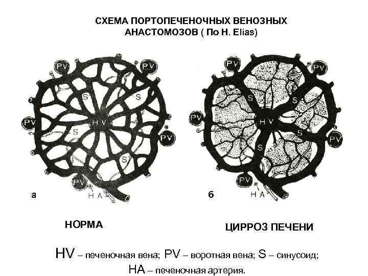 Цирроз печени схема