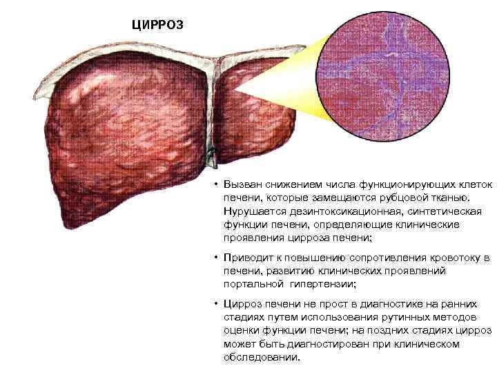 ЦИРРОЗ • Вызван снижением числа функционирующих клеток печени, которые замещаются рубцовой тканью. Нурушается дезинтоксикационная,