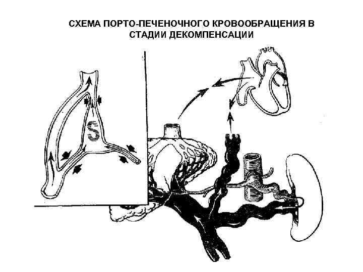 СХЕМА ПОРТО-ПЕЧЕНОЧНОГО КРОВООБРАЩЕНИЯ В СТАДИИ ДЕКОМПЕНСАЦИИ 