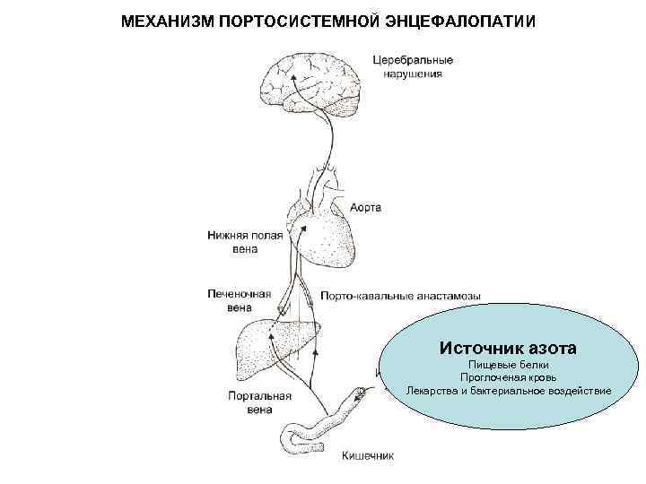 МЕХАНИЗМ ПОРТОСИСТЕМНОЙ ЭНЦЕФАЛОПАТИИ Источник азота Пищевые белки Проглоченая кровь Лекарства и бактериальное воздействие 