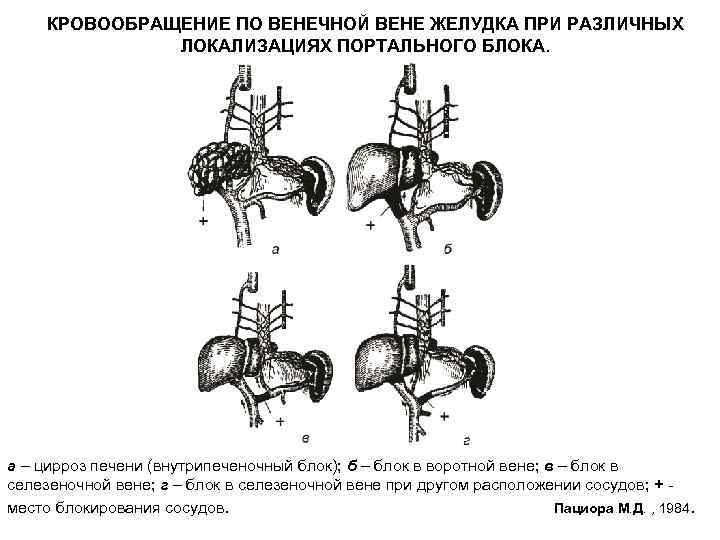 КРОВООБРАЩЕНИЕ ПО ВЕНЕЧНОЙ ВЕНЕ ЖЕЛУДКА ПРИ РАЗЛИЧНЫХ ЛОКАЛИЗАЦИЯХ ПОРТАЛЬНОГО БЛОКА. а – цирроз печени