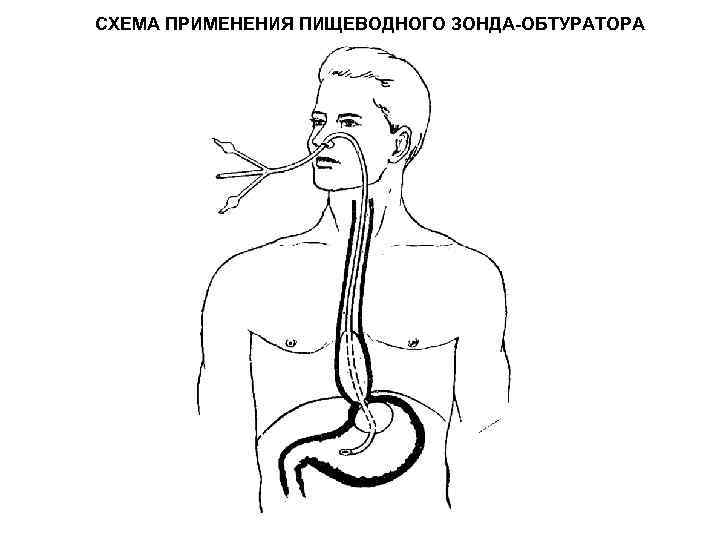 Использование зонда. Зонд пищеводный. Пищеводный зонд схема. Пищеводный обтуратор. Зонд Блекмора пищеводно- желудочный.