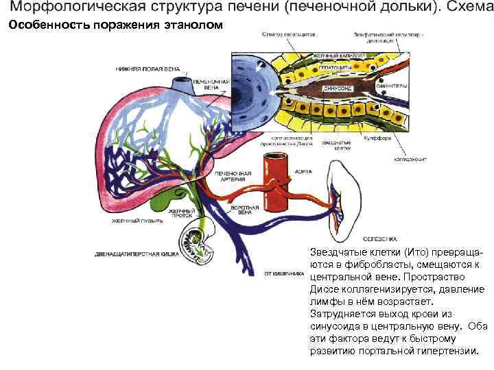 Особенность поражения этанолом Звездчатые клетки (Ито) превращаются в фибробласты, смещаются к центральной вене. Простраство