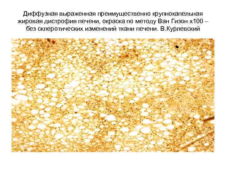 Диффузная выраженная преимущественно крупнокапельная жировая дистрофия печени, окраска по методу Ван Гизон х100 –