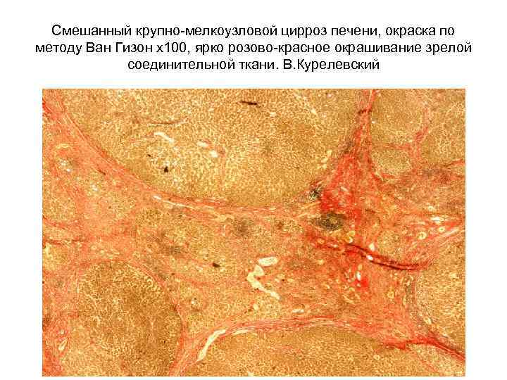 Смешанный крупно-мелкоузловой цирроз печени, окраска по методу Ван Гизон х100, ярко розово-красное окрашивание зрелой