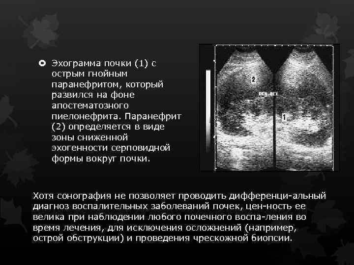  Эхограмма почки (1) с острым гнойным паранефритом, который развился на фоне апостематозного пиелонефрита.