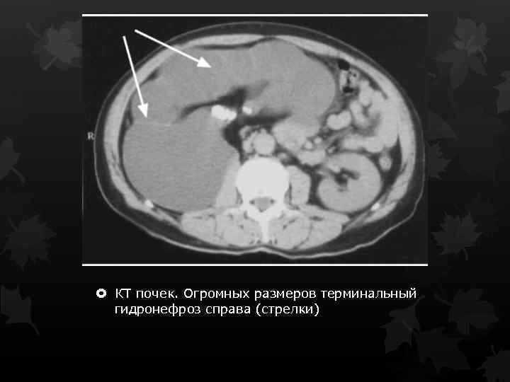  КТ почек. Огромных размеров терминальный гидронефроз справа (стрелки) 