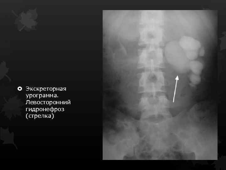  Экскреторная урограмма. Левосторонний гидронефроз (стрелка) 