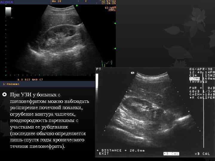  При УЗИ у больных с пиелонефритом можно наблюдать расширение почечной лоханки, огрубение контура