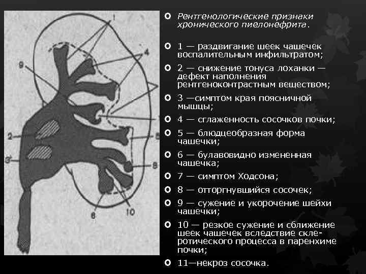  Рентгенологические признаки хронического пиелонефрита. 1 — раздвигание шеек чашечек воспалительным инфильтратом; 2 —