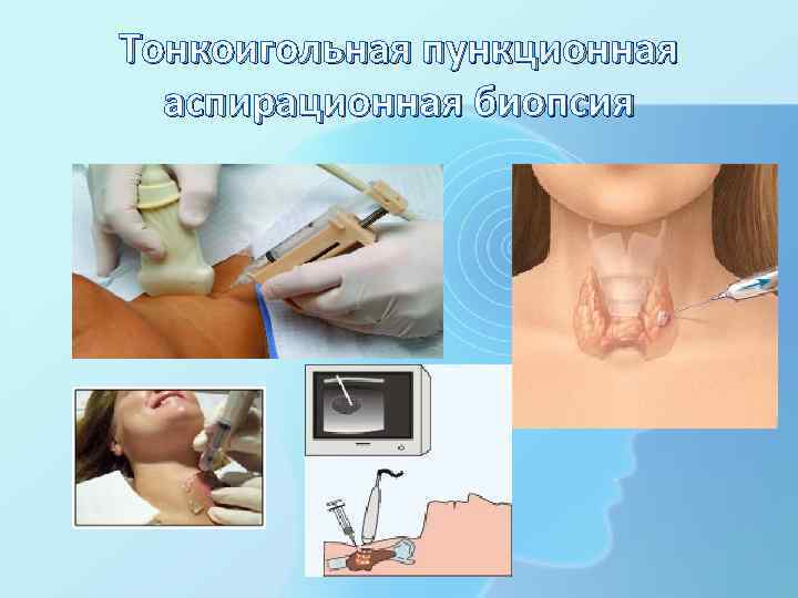 Тонкоигольная пункционная аспирационная биопсия 