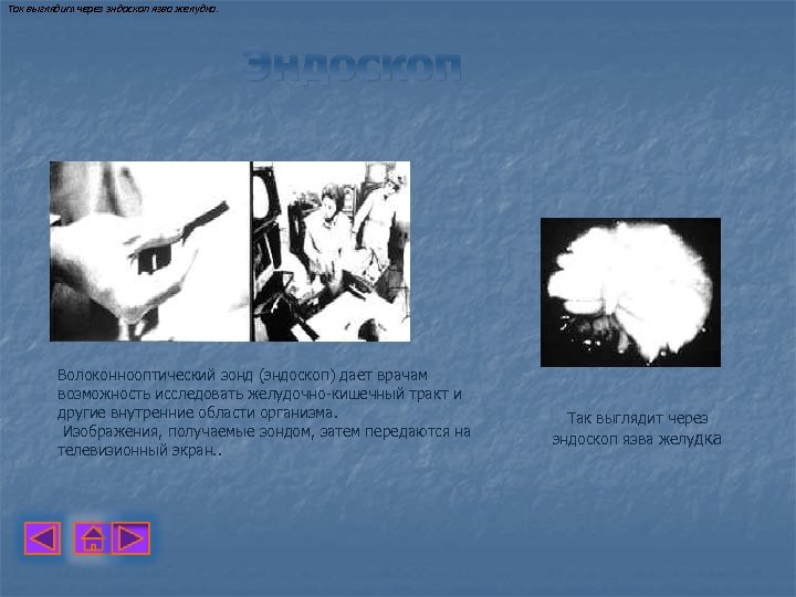 Так выглядит через эндоскоп язва желудка. Эндоскоп Волоконнооптический зонд (эндоскоп) дает врачам возможность исследовать