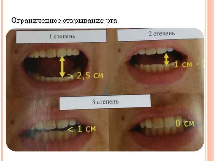 Ограниченное открывание рта 