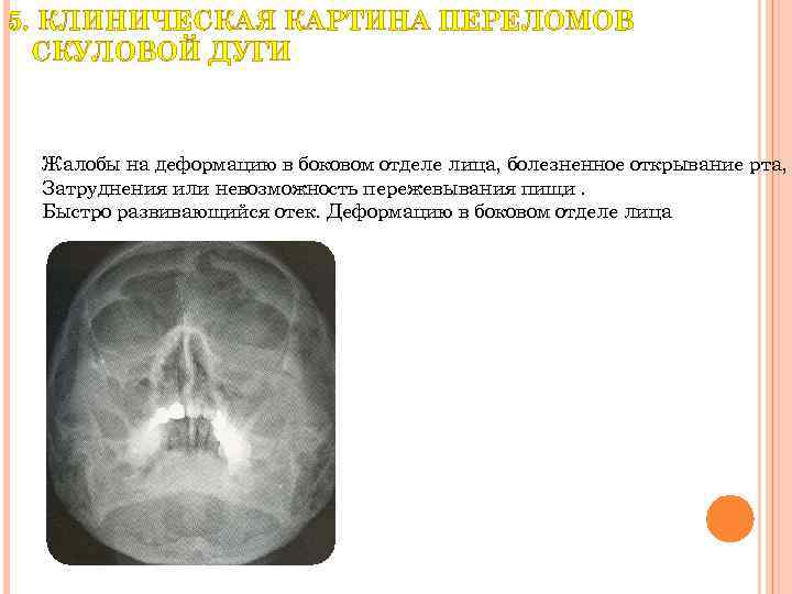 Переломы скуловой кости и дуги презентация