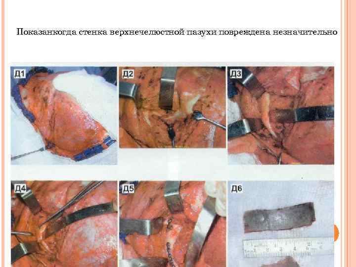 Показанкогда стенка верхнечелюстной пазухи повреждена незначительно 