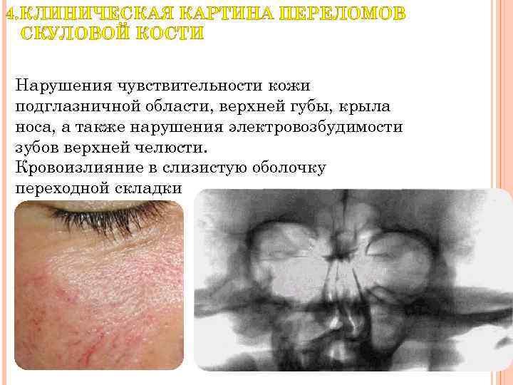 4. КЛИНИЧЕСКАЯ КАРТИНА ПЕРЕЛОМОВ СКУЛОВОЙ КОСТИ Нарушения чувствительности кожи подглазничной области, верхней губы, крыла