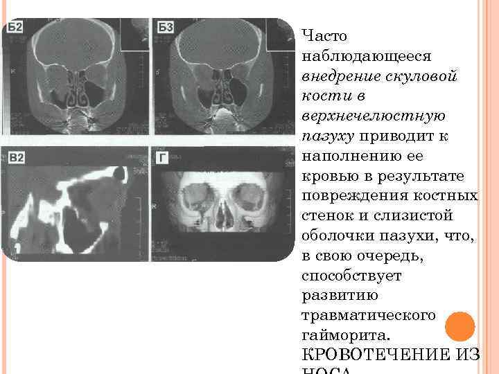 Часто наблюдающееся внедрение скуловой кости в верхнечелюстную пазуху приводит к наполнению ее кровью в