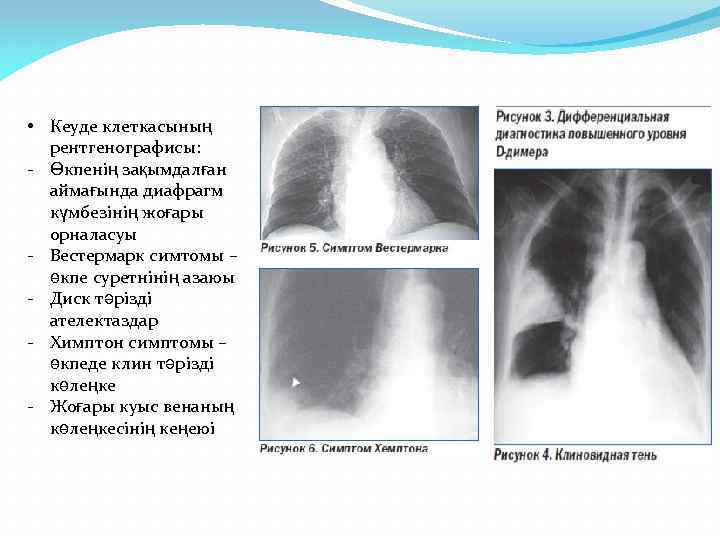  • Кеуде клеткасының рентгенографисы: - Өкпенің зақымдалған аймағында диафрагм күмбезінің жоғары орналасуы -