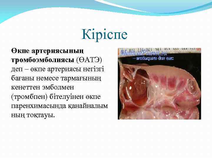 Кіріспе Өкпе артериясының тромбоэмболиясы (ӨАТЭ) деп – өкпе артериясы негізгі бағаны немесе тармағының кенеттен