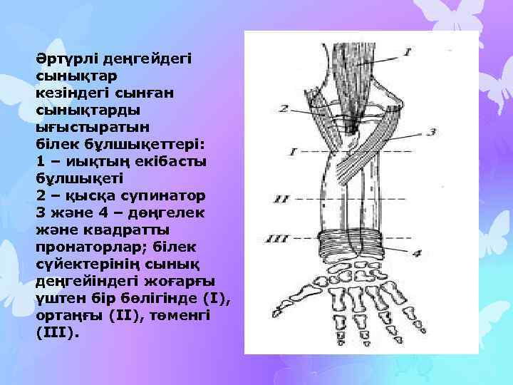 Әртүрлі деңгейдегі сынықтар кезіндегі сынған сынықтарды ығыстыратын білек бұлшықеттері: 1 – иықтың екібасты бұлшықеті