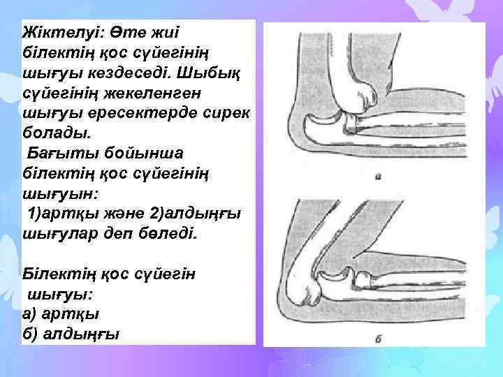 Жіктелуі: Өте жиі білектің қос сүйегінің шығуы кездеседі. Шыбық сүйегінің жекеленген шығуы ересектерде сирек