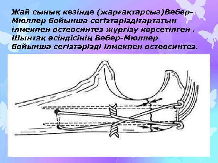 Жай сынық кезінде (жарғақтарсыз)Вебер. Мюллер бойынша сегізтәріздітартатын ілмекпен остеосинтез жүргізу көрсетілген. Шынтақ өсіндісінің Вебер-Мюллер