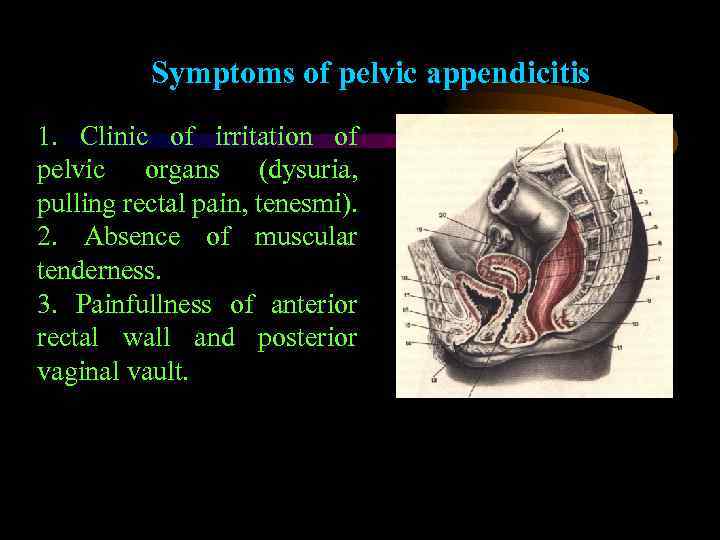 Symptoms of pelvic appendicitis 1. Clinic of irritation of pelvic organs (dysuria, pulling rectal