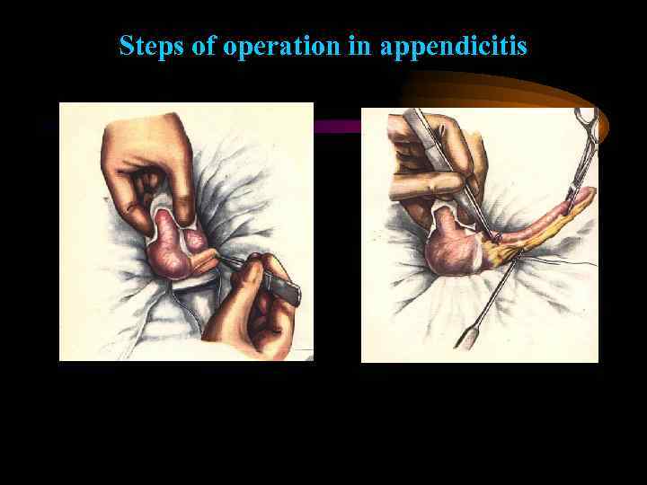 Steps of operation in appendicitis 