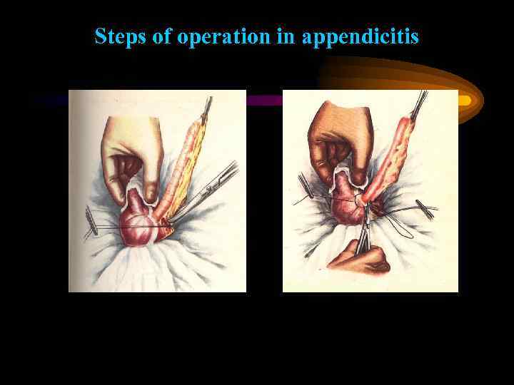 Steps of operation in appendicitis 